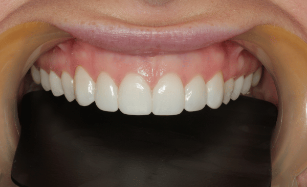 After Image - Creffield Lodge Dental Practice