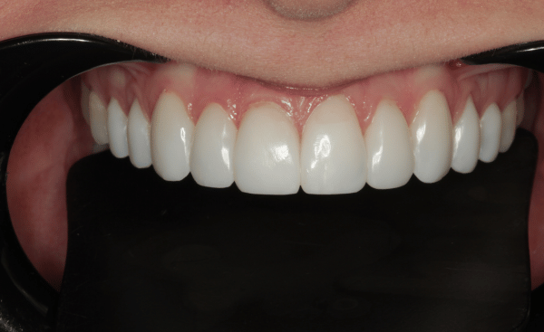 After Image - Creffield Lodge Dental Practice