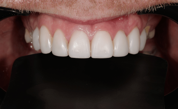 After Image - Creffield Lodge Dental Practice
