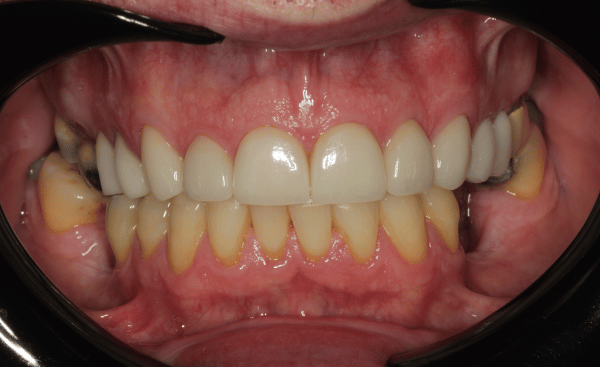 After Image - Creffield Lodge Dental Practice