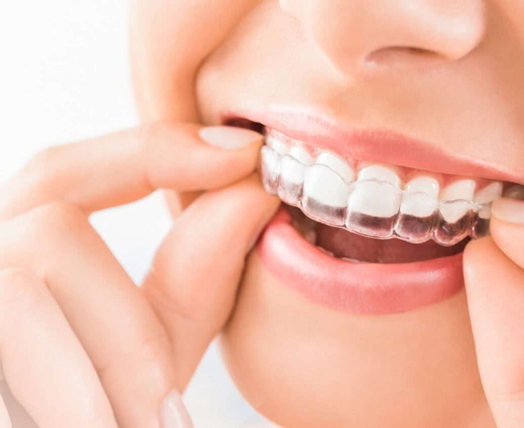 Invisible Braces