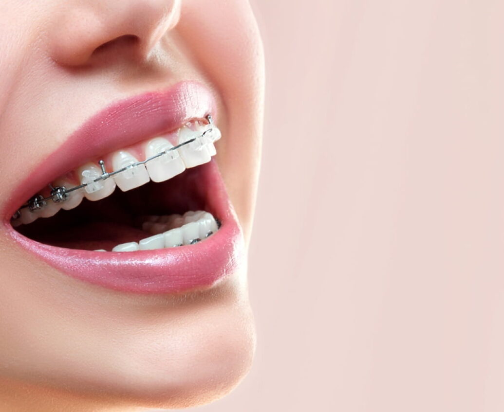 Traditional Braces