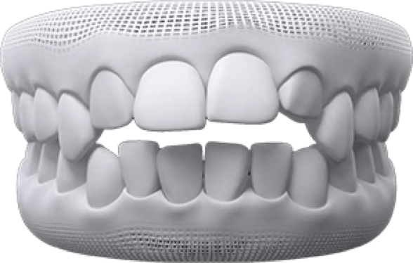 Openbite treatment