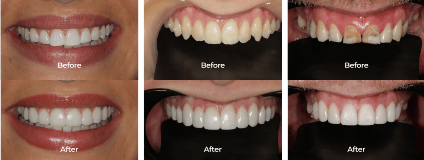 Composite Bonding