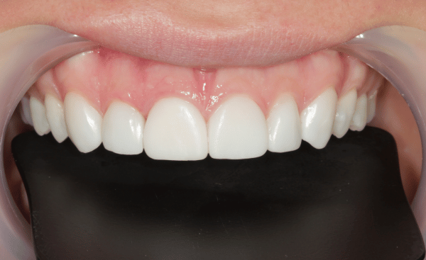 After Image - Creffield Lodge Dental Practice
