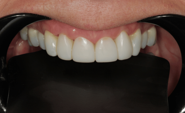 After Image - Creffield Lodge Dental Practice