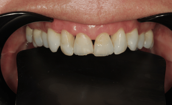Before Image - Creffield Lodge Dental Practice