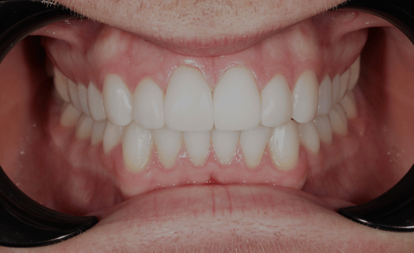 After Image - Creffield Lodge Dental Practice