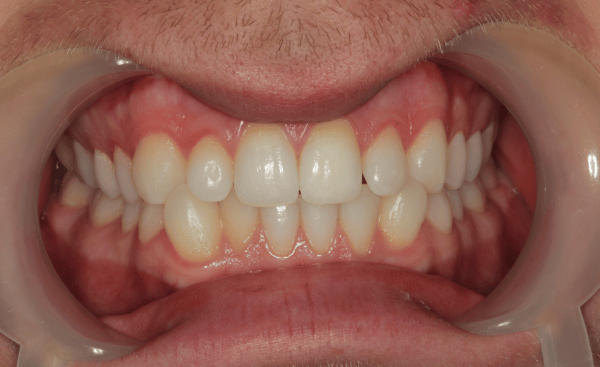Before Image - Creffield Lodge Dental Practice
