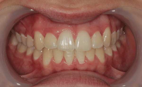 After Image - Creffield Lodge Dental Practice