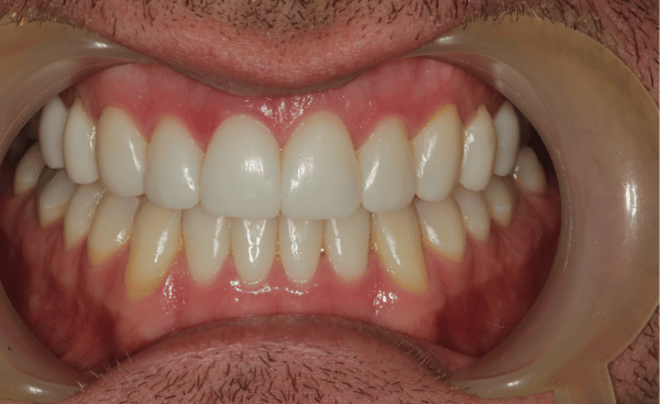 Invisalign Case 1 After
