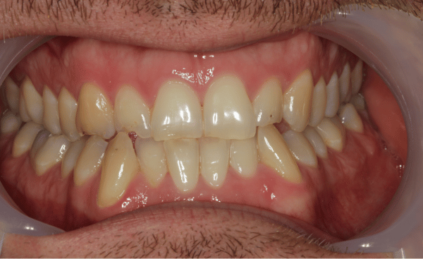 Invisalign Case 1 Before
