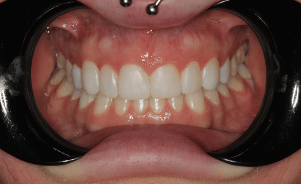 Invisalign Case 2 After