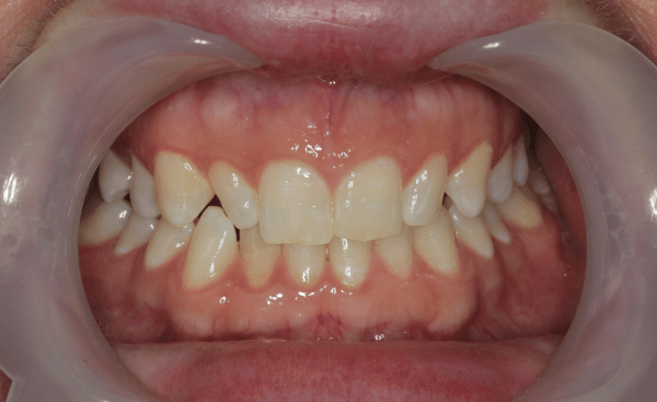 Invisalign Case 2 Before
