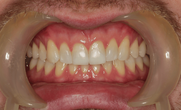 Invisalign Case 3 After