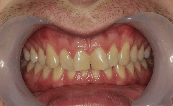 Invisalign Case 3 Before