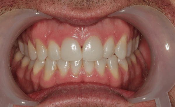Invisalign Case 4 After