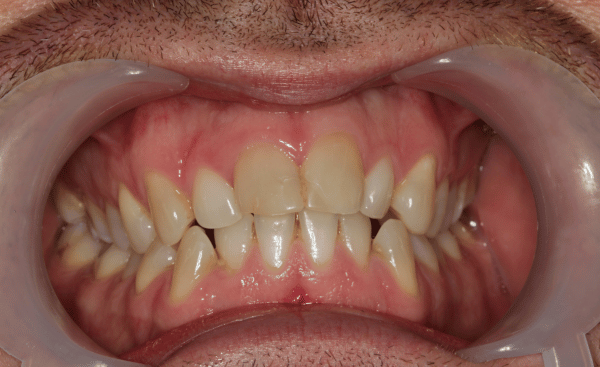 Invisalign Case 4 Before