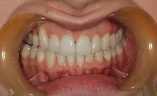 Invisalign Case 5 After