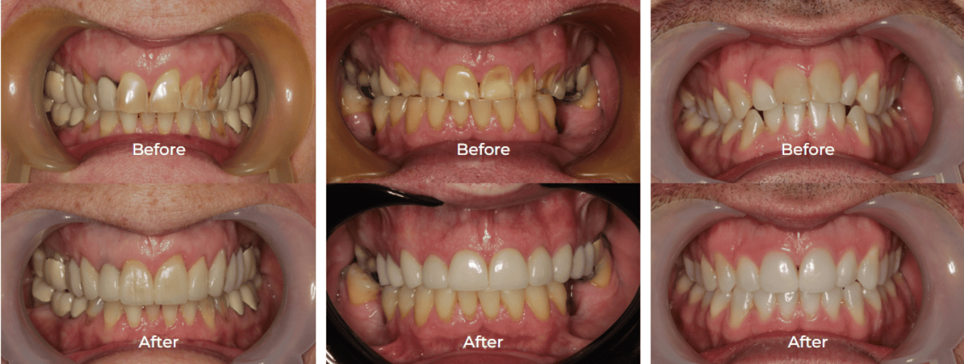 Porcelain Veneers